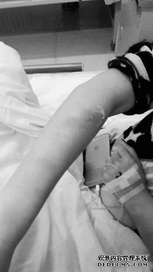 被燙傷的客人正在醫(yī)院接受治療。