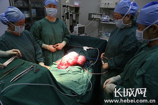 大型子宮肌瘤。